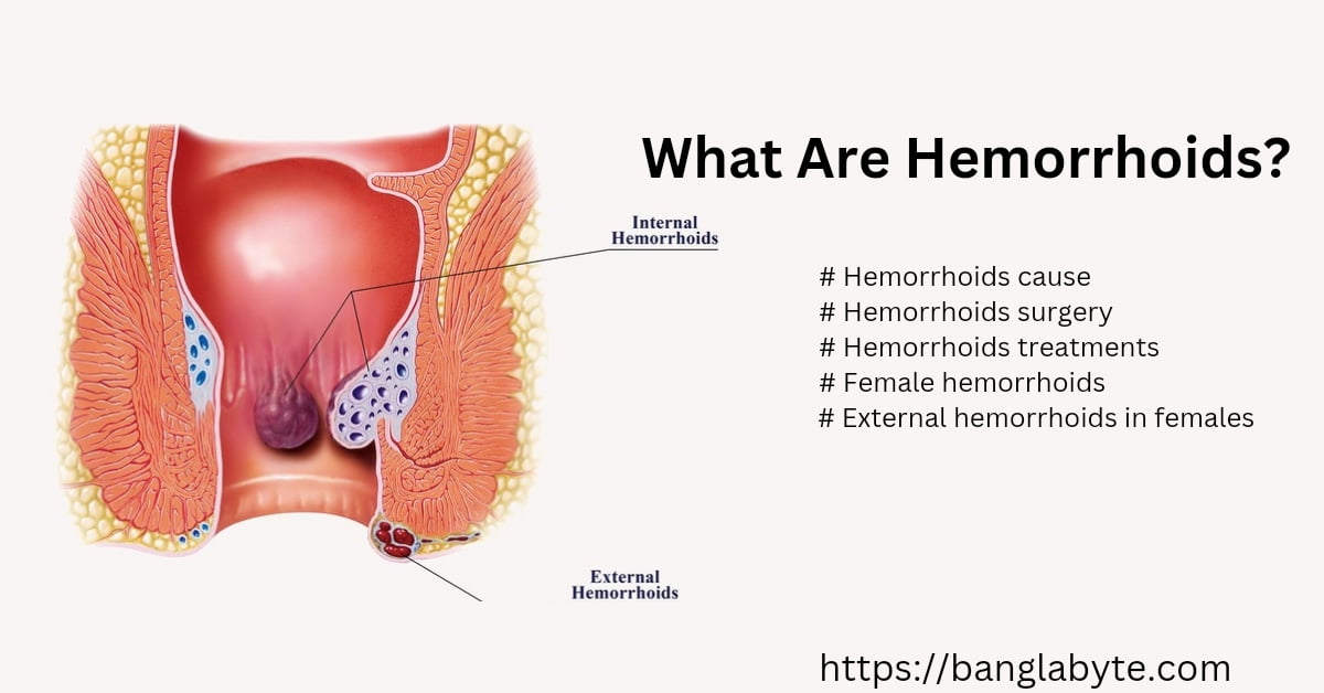 hemorrhoids